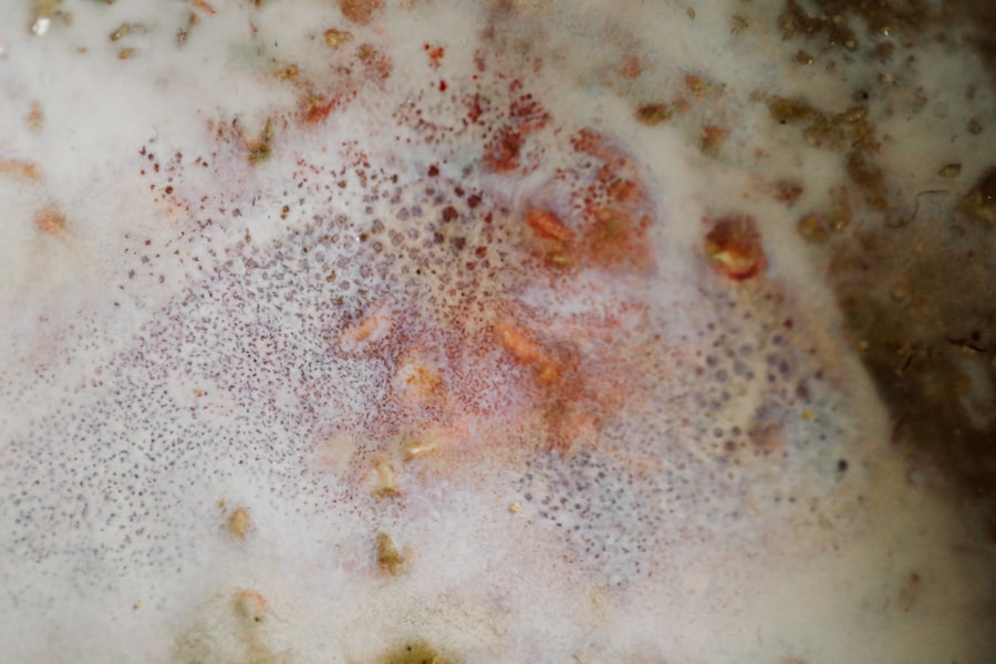 yeast infection