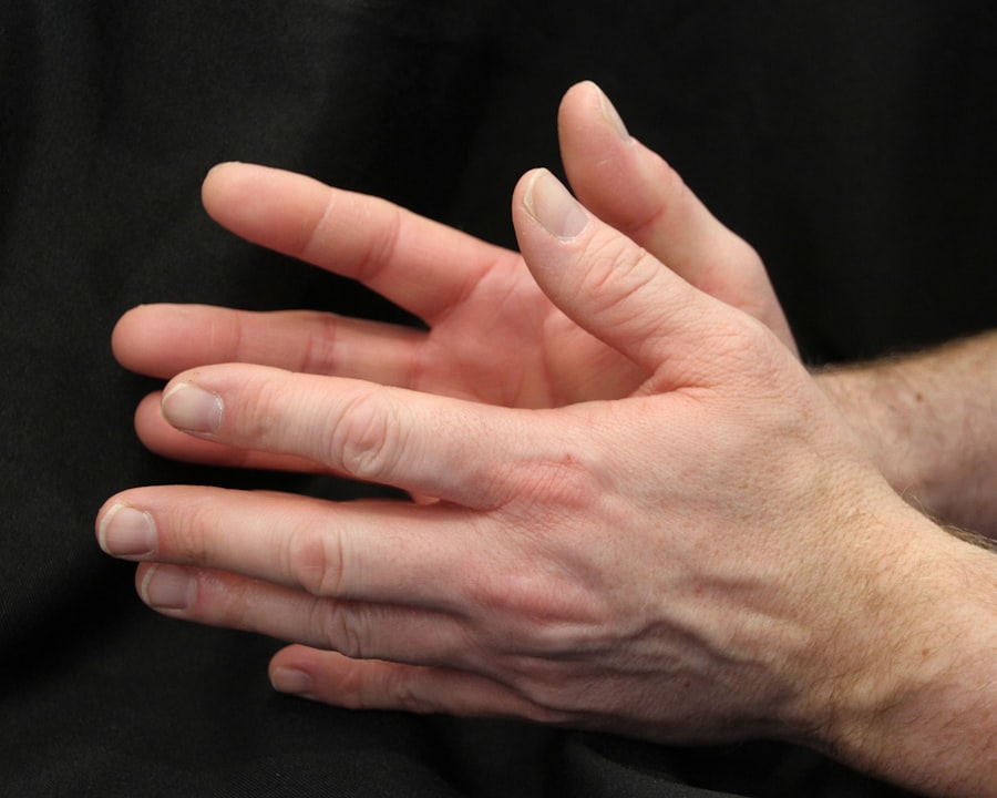 rheumatoid arthritis