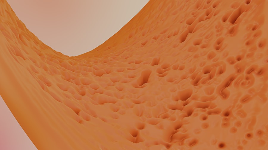 acid reflux
