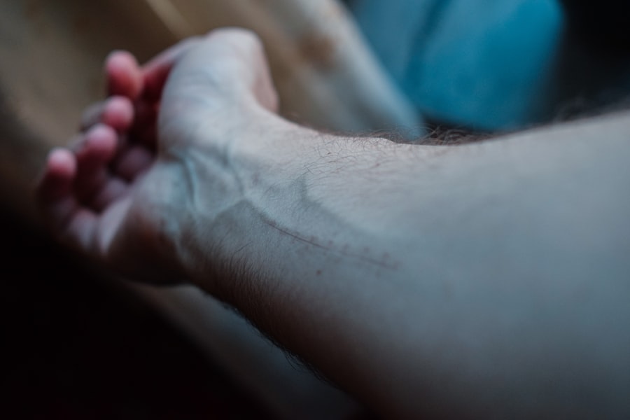 Photo deep vein thrombosis