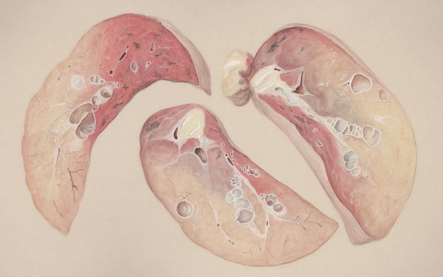 Photo crohns disease
