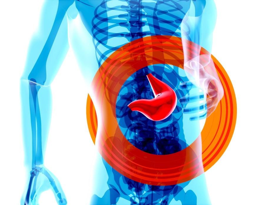 Photo stomach ulcers